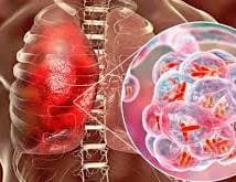 Hoy es el Día Internacional de la Tuberculosis en cárceles de RD se reportan casos de esa enfermedad
