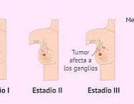 Especialista dice cáncer de mama también podría afectar a mujeres jóvenes